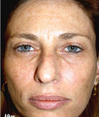 IPL Photo Facial Before & After Patient #1399