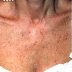 IPL Photo Facial Before & After Patient #1400