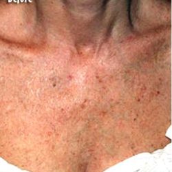IPL Photo Facial Before & After Patient #1400