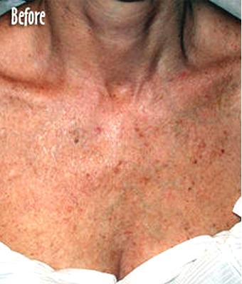 IPL Photo Facial Before & After Patient #1400