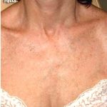 IPL Photo Facial Before & After Patient #1400