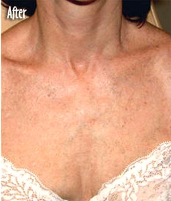 IPL Photo Facial Before & After Patient #1400
