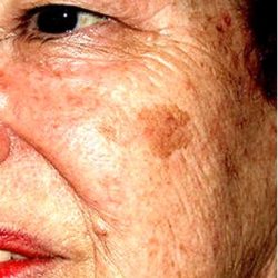 IPL Photo Facial Before & After Patient #1401