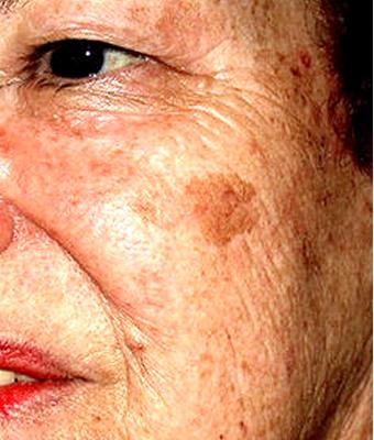 IPL Photo Facial Before & After Patient #1401