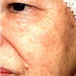 IPL Photo Facial Before & After Patient #1401