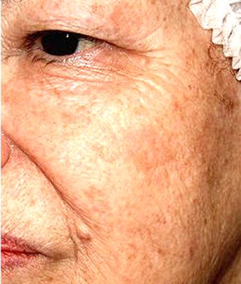 IPL Photo Facial Before & After Patient #1401