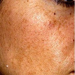 IPL Photo Facial Before & After Patient #1402