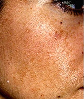 IPL Photo Facial Before & After Patient #1402