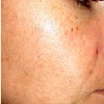 IPL Photo Facial Before & After Patient #1402