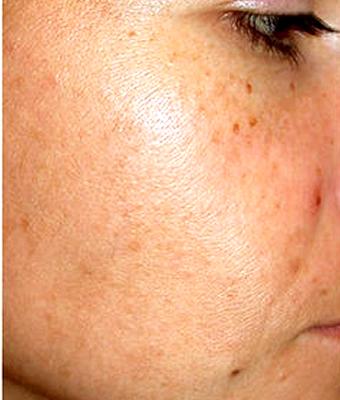 IPL Photo Facial Before & After Patient #1402