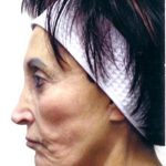 IPL Photo Facial Before & After Patient #1403