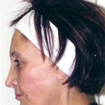 IPL Photo Facial Before & After Patient #1403