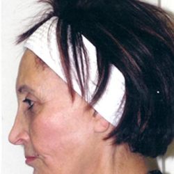 IPL Photo Facial Before & After Patient #1403