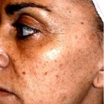 IPL Photo Facial Before & After Patient #1404