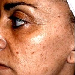 IPL Photo Facial Before & After Patient #1404