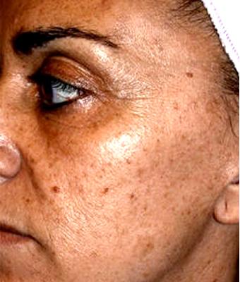 IPL Photo Facial Before & After Patient #1404