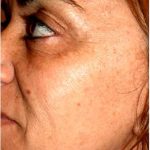 IPL Photo Facial Before & After Patient #1404