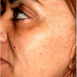 IPL Photo Facial Before & After Patient #1404