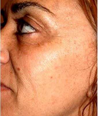 IPL Photo Facial Before & After Patient #1404