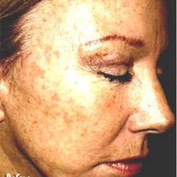 IPL Photo Facial Before & After Patient #1405