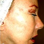 IPL Photo Facial Before & After Patient #1405