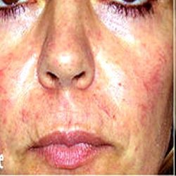 IPL Photo Facial Before & After Patient #1406