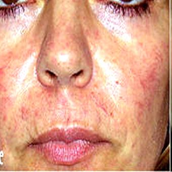 IPL Photo Facial Before & After Patient #1406