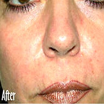 IPL Photo Facial Before & After Patient #1406