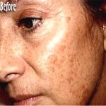 IPL Photo Facial Before & After Patient #1407