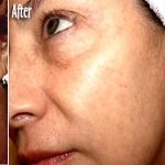 IPL Photo Facial Before & After Patient #1407