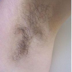 Laser Hair Removal Before & After Patient #1531