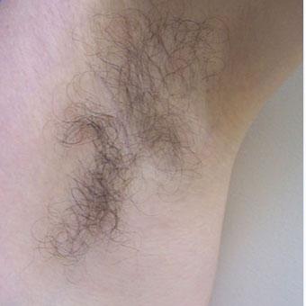 Laser Hair Removal Before & After Patient #1531