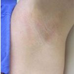 Laser Hair Removal Before & After Patient #1531