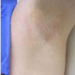 Laser Hair Removal Before & After Patient #1531