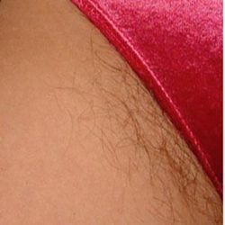 Laser Hair Removal Before & After Patient #1532