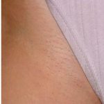 Laser Hair Removal Before & After Patient #1532