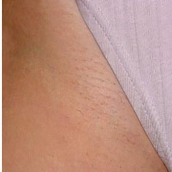 Laser Hair Removal Before & After Patient #1532