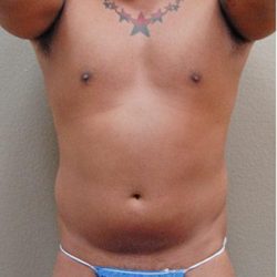 Liposuction Before & After Patient #1176