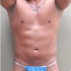 Liposuction Before & After Patient #1176