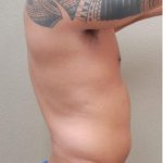 Liposuction Before & After Patient #1176