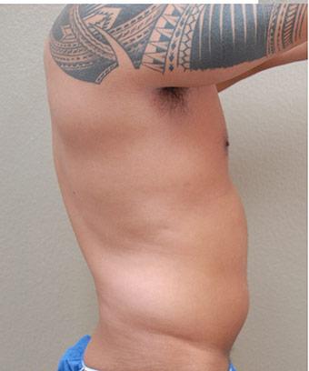 Liposuction Before & After Patient #1176