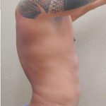 Liposuction Before & After Patient #1176