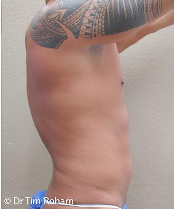 Liposuction Before & After Patient #1176