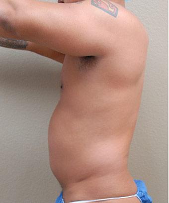 Liposuction Before & After Patient #1176