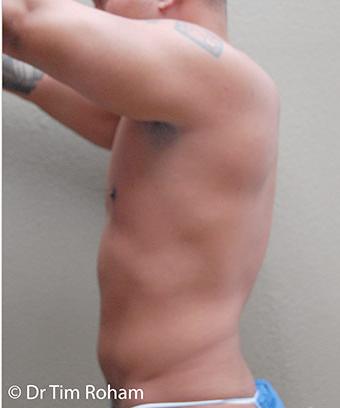 Liposuction Before & After Patient #1176