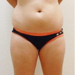 Liposuction Before & After Patient #1177