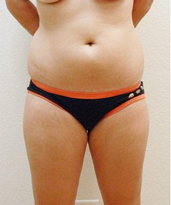 Liposuction Before & After Patient #1177