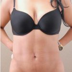 Liposuction Before & After Patient #1179