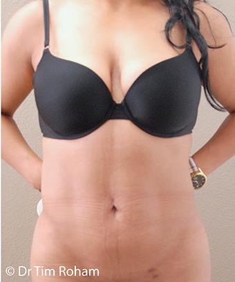 Liposuction Before & After Patient #1179