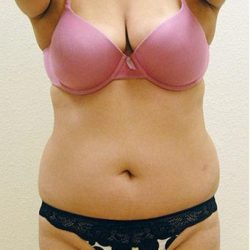 Liposuction Before & After Patient #1180